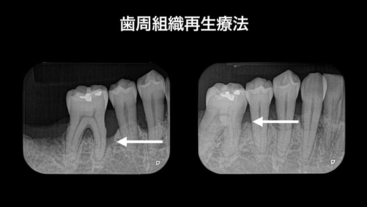 歯周組織再生療法