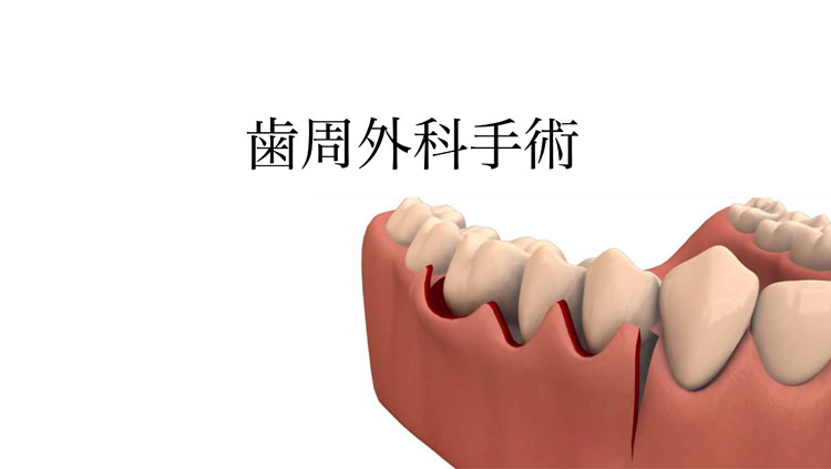 歯周外科
